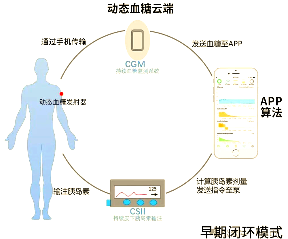 美敦力780g 革命性的閉環式胰島素泵，引領高效、穩定與精確的糖尿病管理